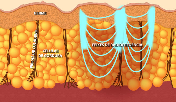 Mecanismo de Ação da Radiofrequência