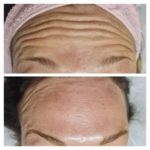 ESSENZA ESTÉTICA CURITIBA - BOTOX10