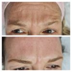 ESSENZA ESTÉTICA CURITIBA - BOTOX11