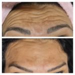 ESSENZA ESTÉTICA CURITIBA - BOTOX13