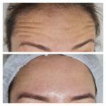 ESSENZA ESTÉTICA CURITIBA - BOTOX14