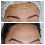 ESSENZA ESTÉTICA CURITIBA - BOTOX3