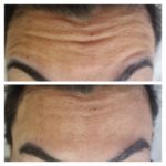 ESSENZA ESTÉTICA CURITIBA - BOTOX6